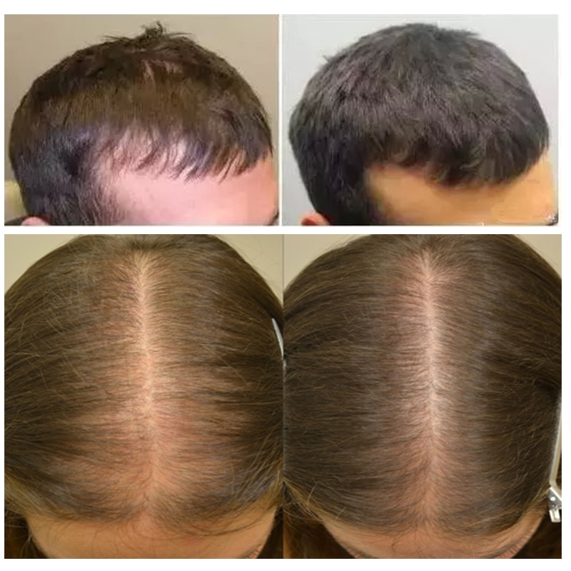 Волосы растут за неделю. Андрогенная алопеция миноксидил. Миноксидил 5 для волос для мужчин для головы.