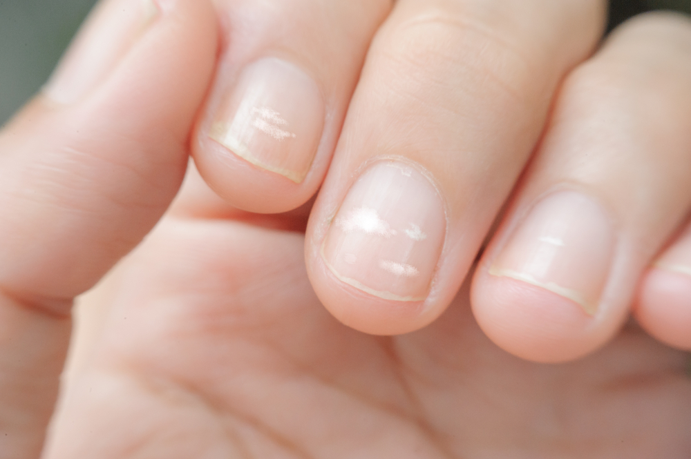Tâche blanche sur les ongles : comment les faire disparaitre ?
