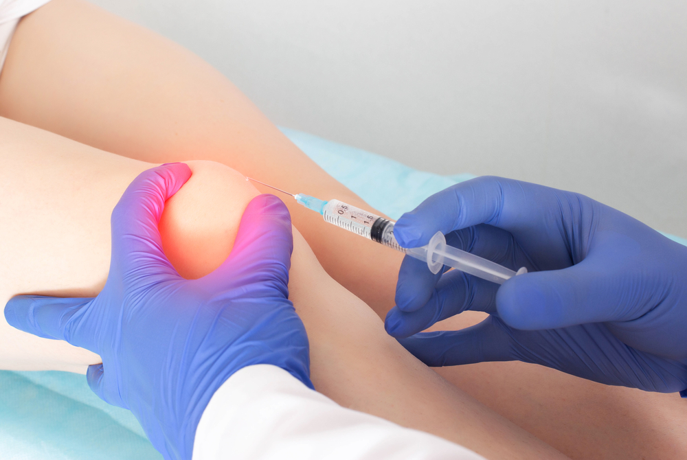 Injection acide hyaluronique genou : comment se passe cette procédure ?