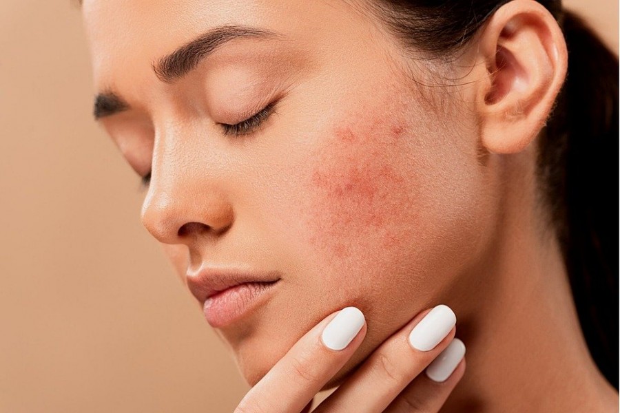 Cicatrice acné : comment y remédier ?