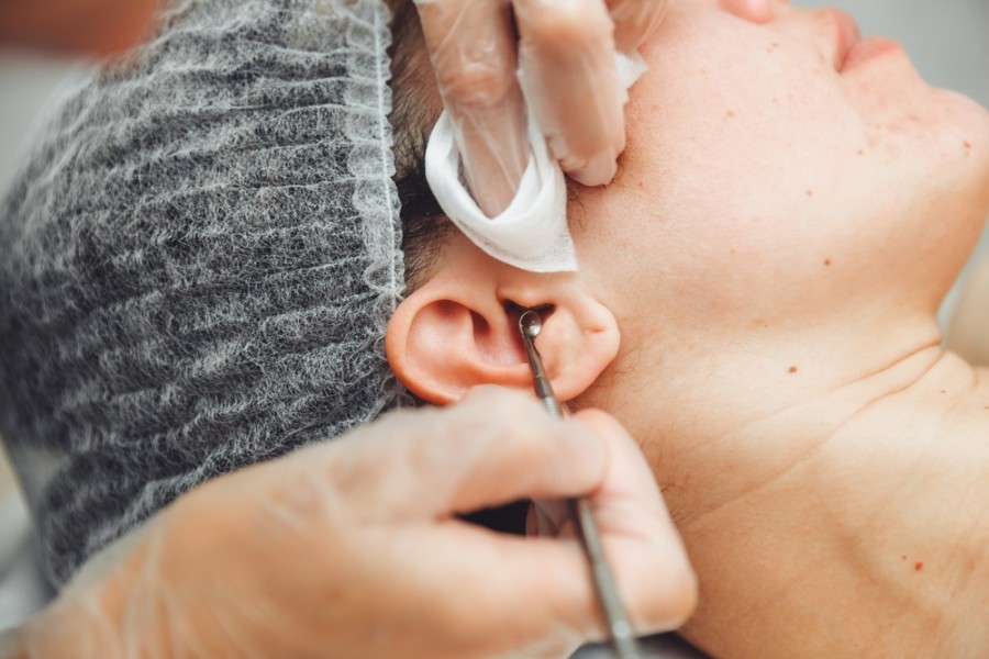 Comment enlever un point noir dans l'oreille ?