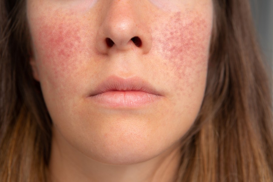 La couperose au visage : quel traitement pour la rosacée ?