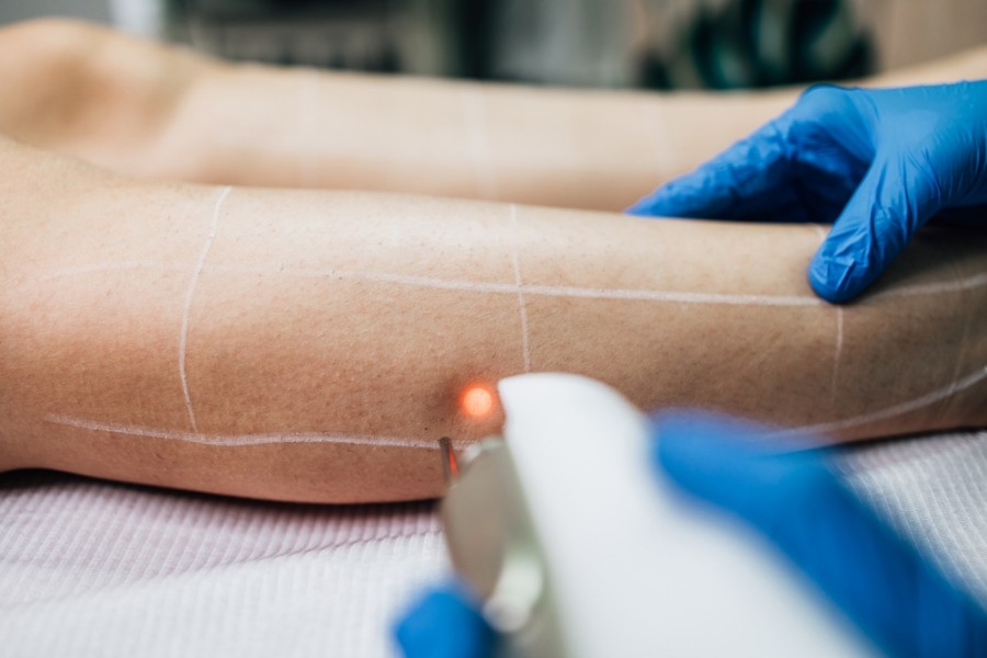 Epilation laser ratée : que faire ?