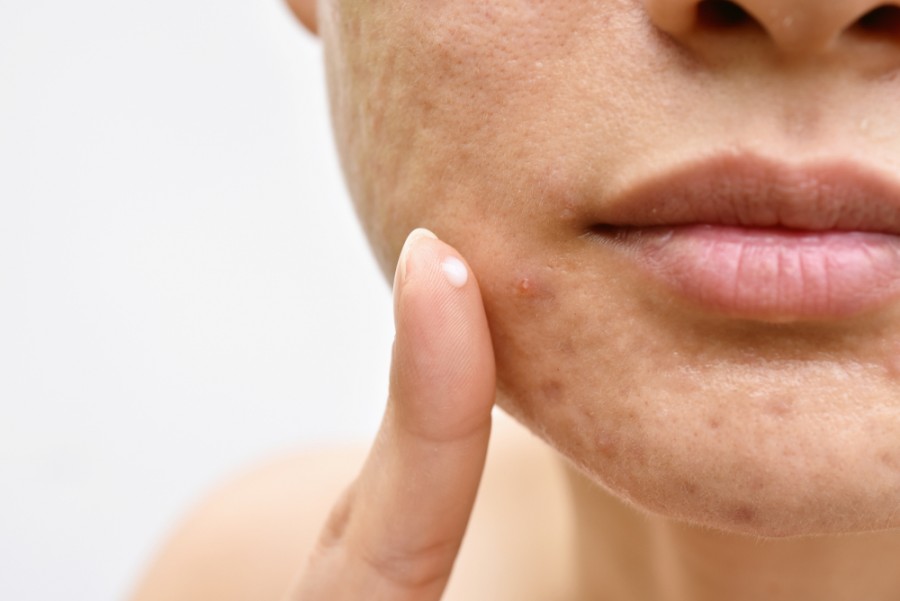 Quels sont les traitements médicaux recommandés pour les cicatrices d'acné sur le visage ?
